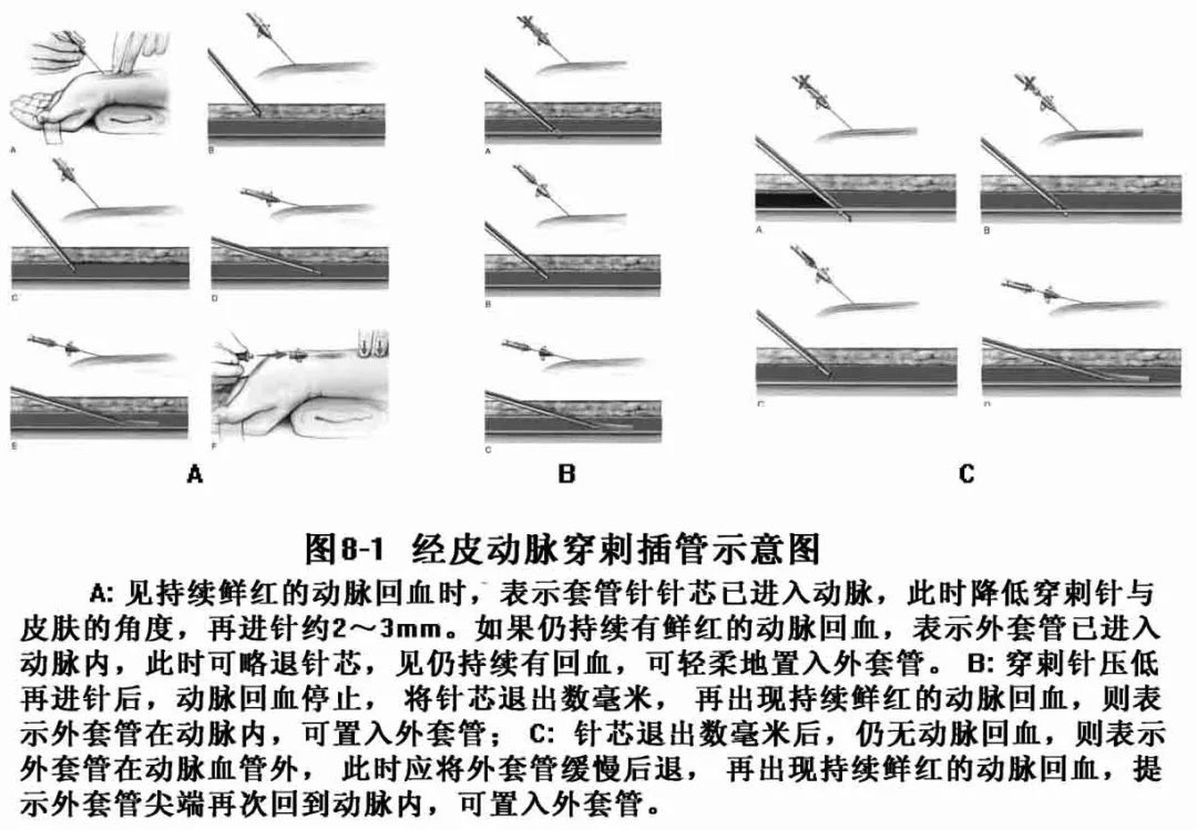 橈動脈穿定位法最新步驟指南與操作解析